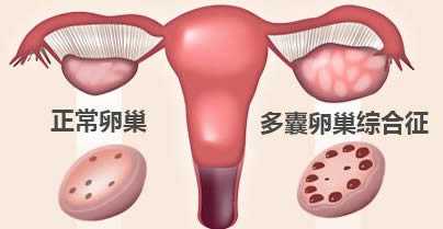 试管引发盆腔炎的潜在因素解析